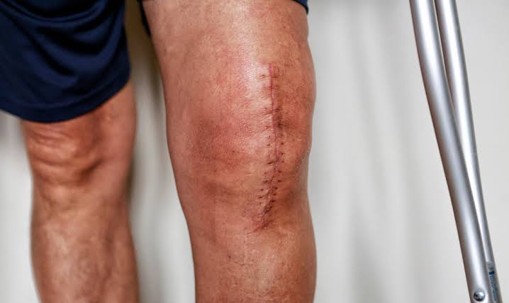 Activities After Total Knee Replacement