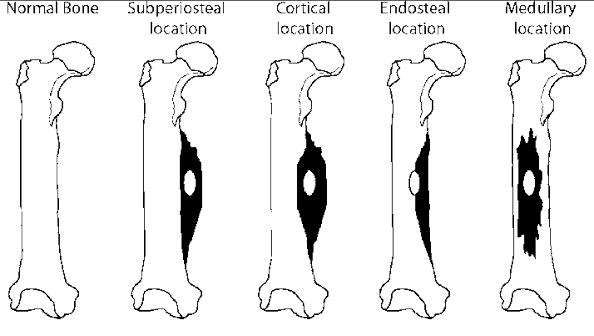 Osteoid Osteoma