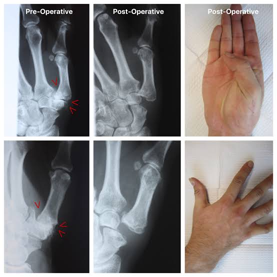 Thumb Carpometacarpal (CMC) Arthroplasty