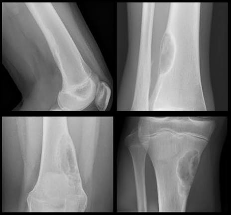 Nonossifying Fibroma
