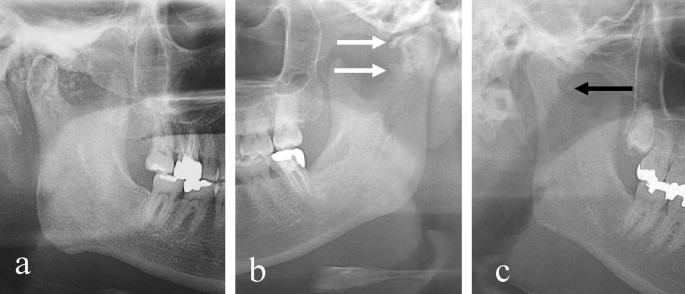 Synovial Chondromatosis