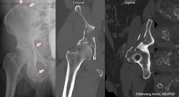 Acetabular Fractures