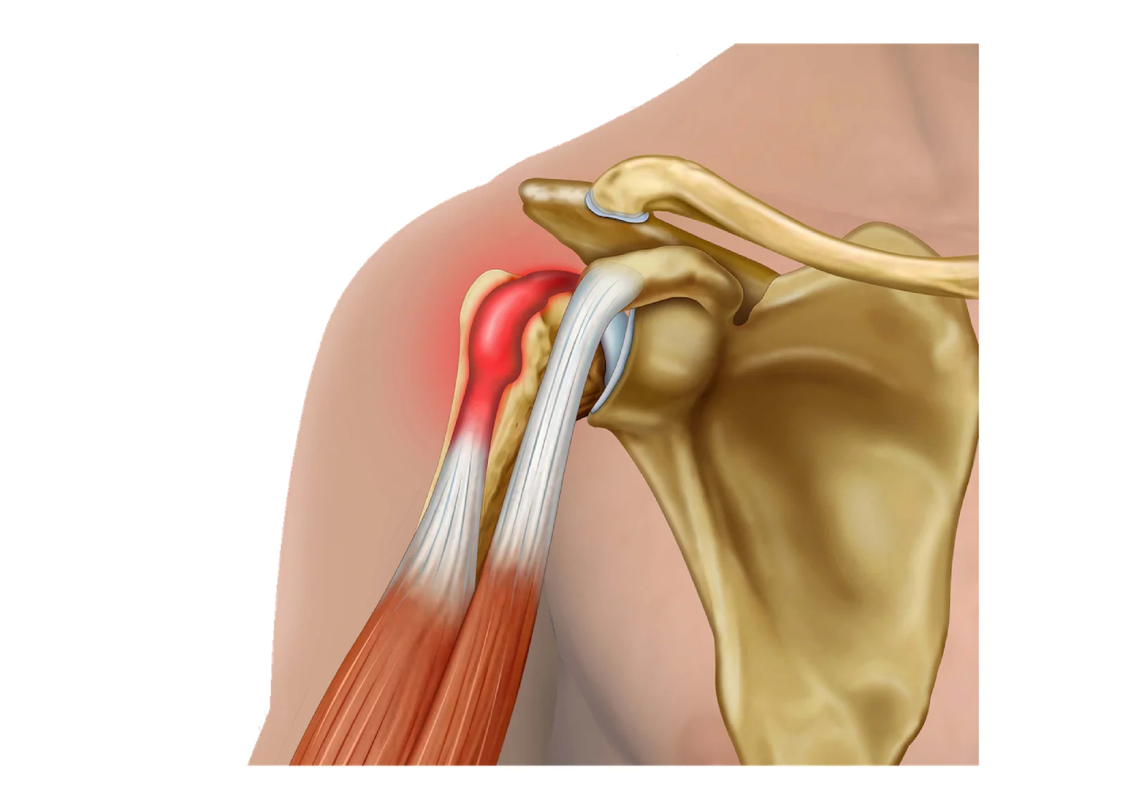 Biceps Tendinitis