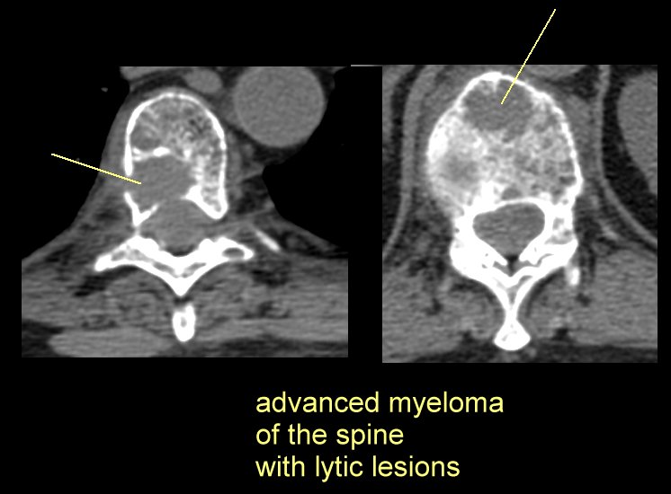 Multiple Myeloma/Plasmacytoma