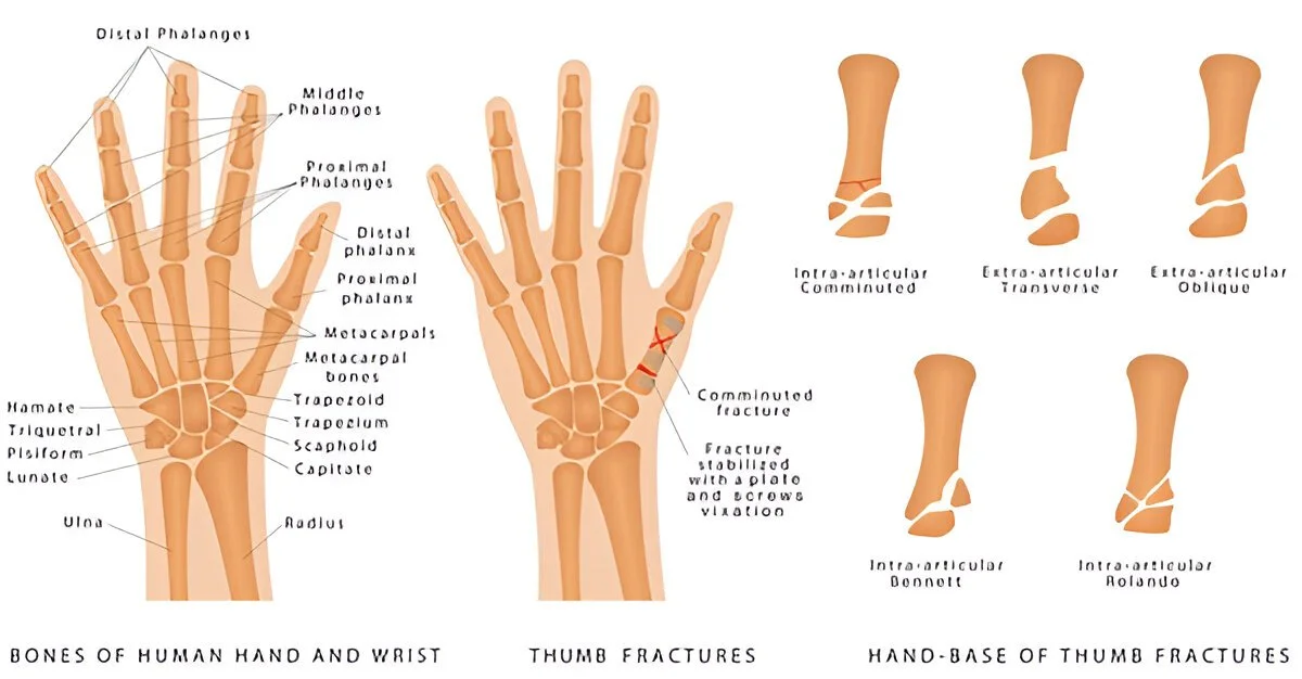 Thumb Fractures