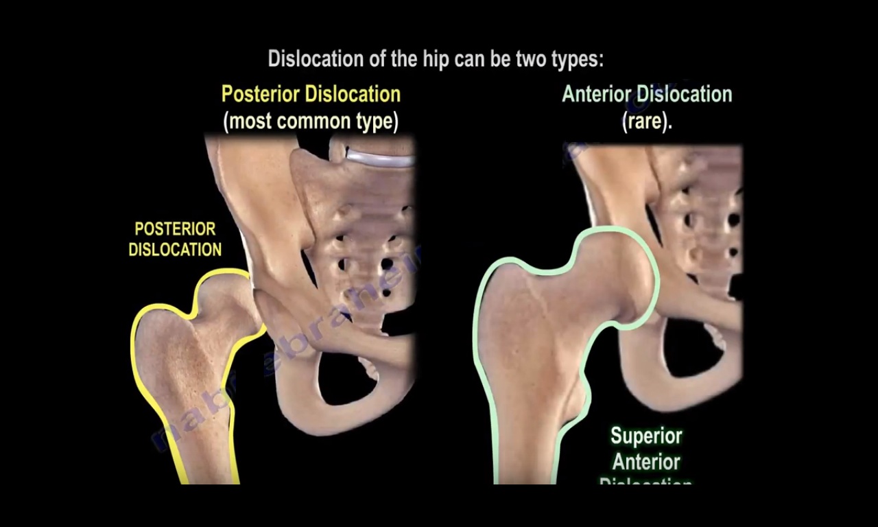 Hip Dislocation