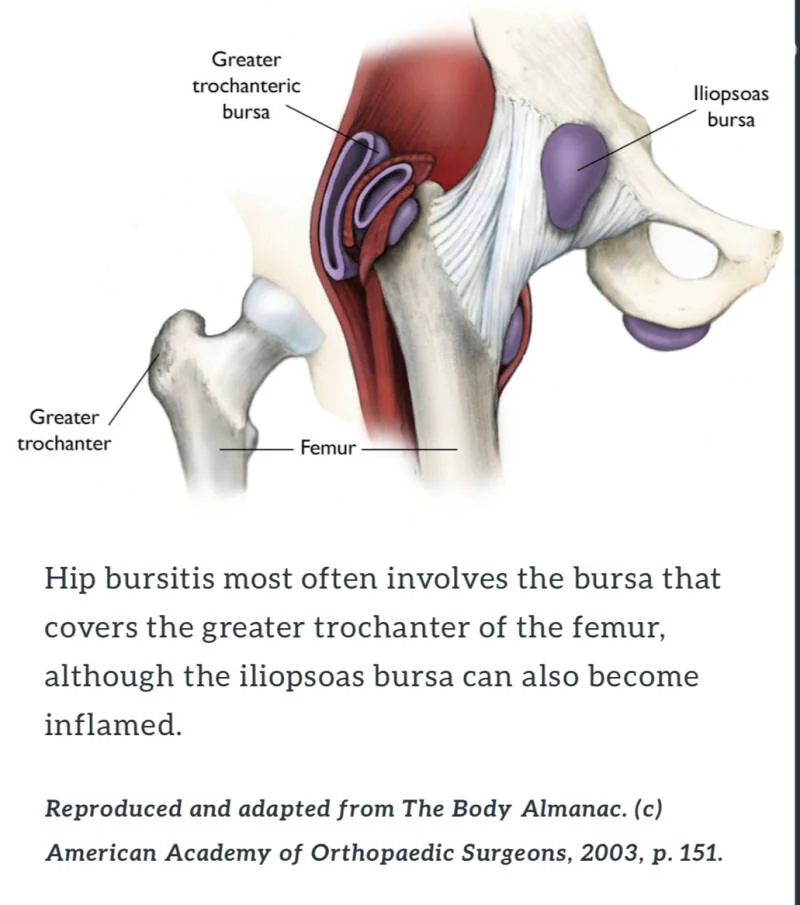 Hip Bursitis