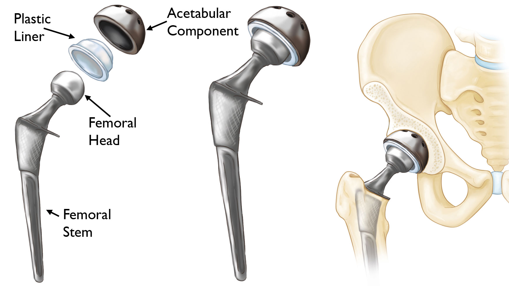 Patient Story: Hip Resurfacing - OrthoInfo - AAOS