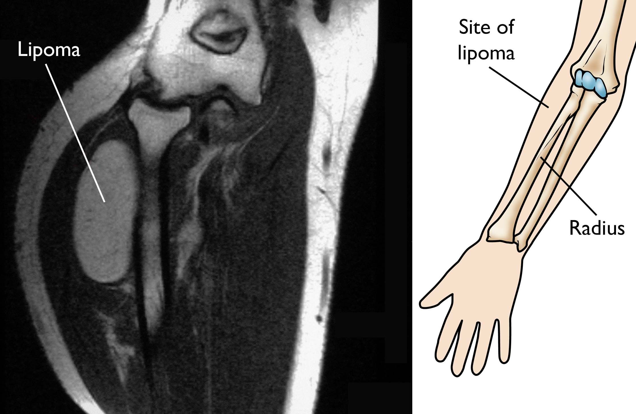 Lipoma and Atypical Lipomatous Tumors