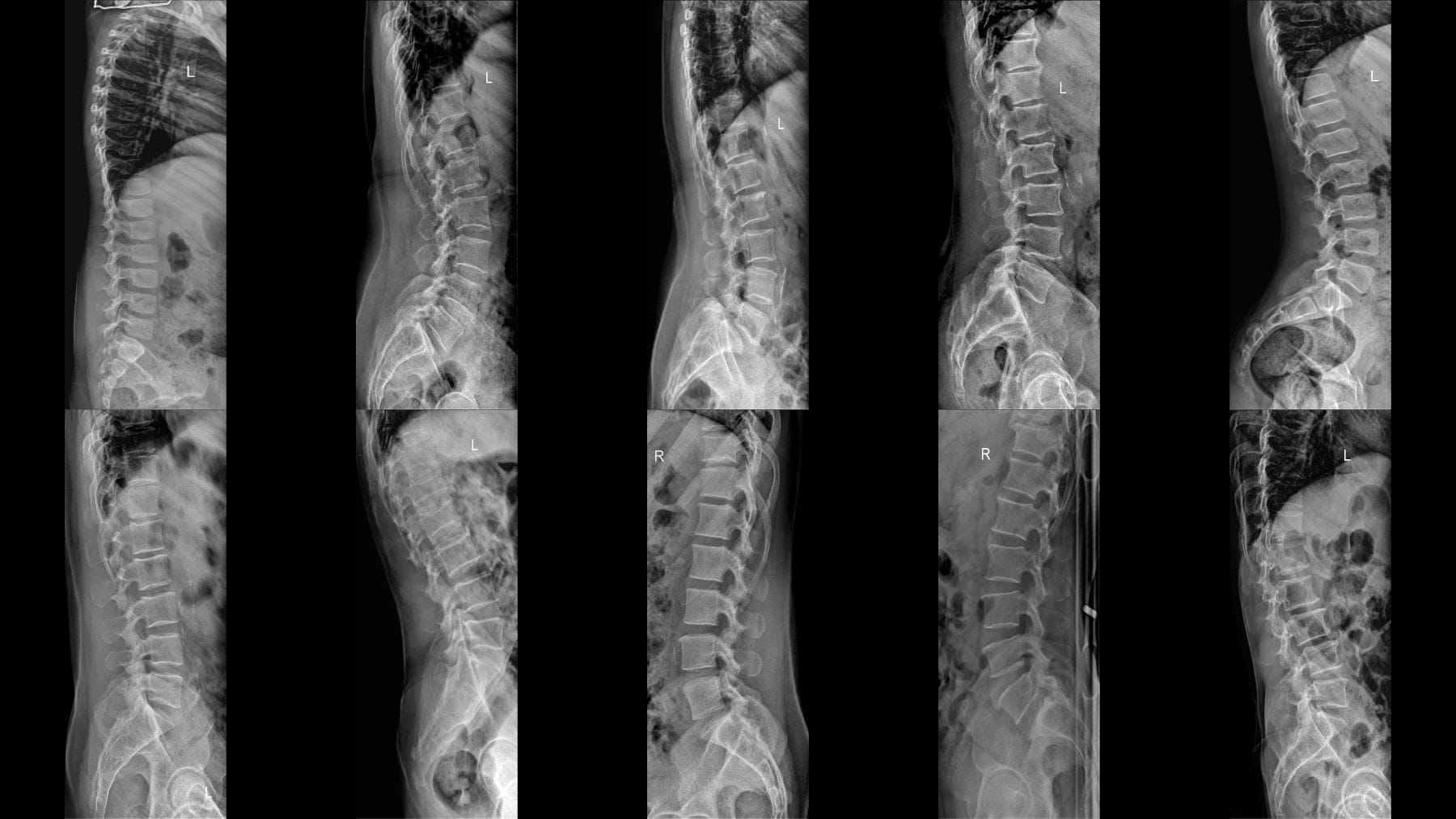 Achondroplasia