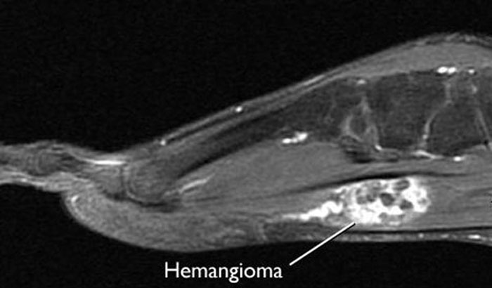 Hemangiomas and Vascular Malformations