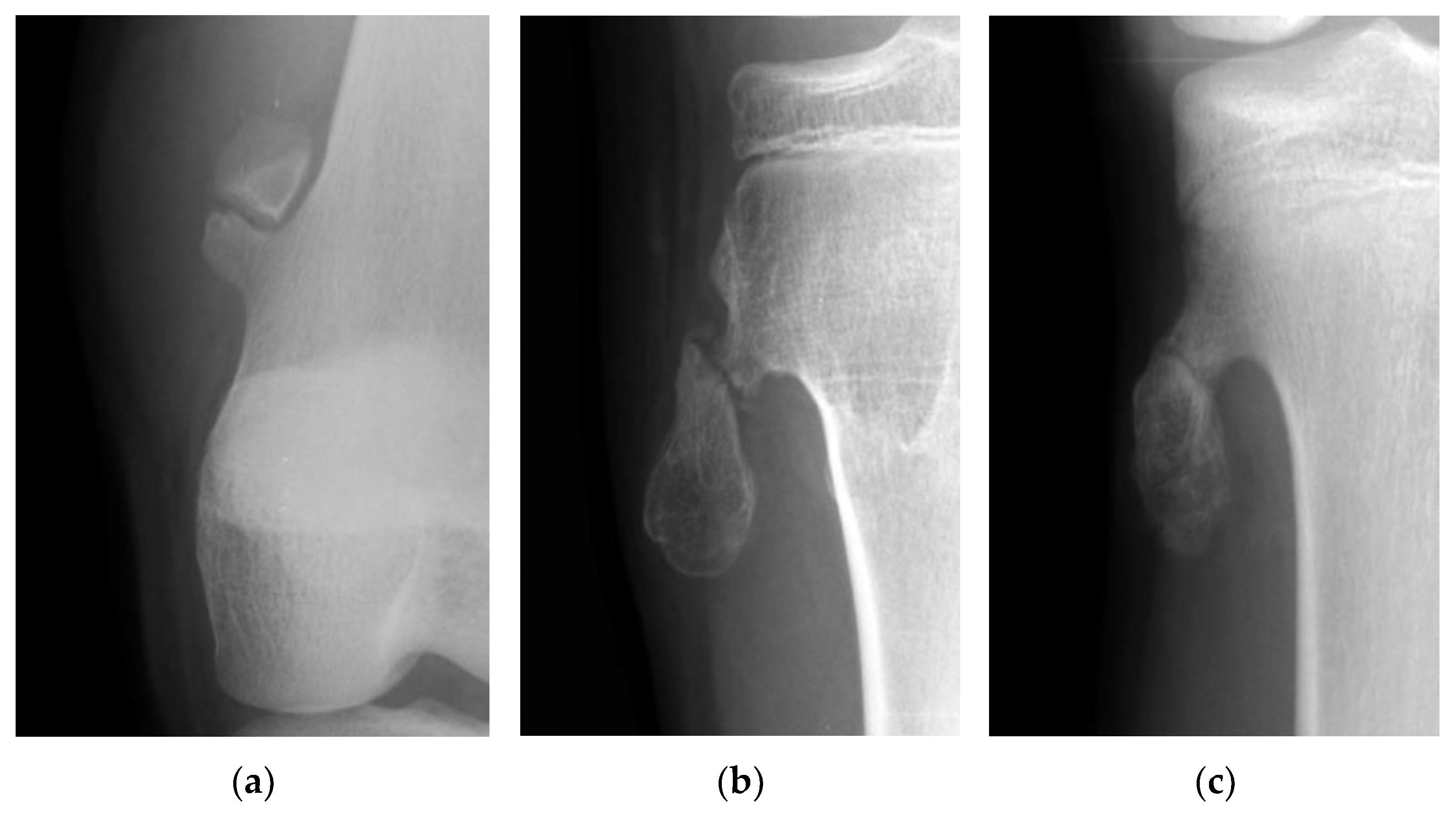 Osteochondroma