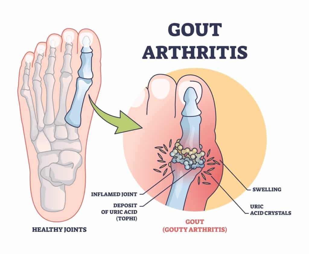 Gout