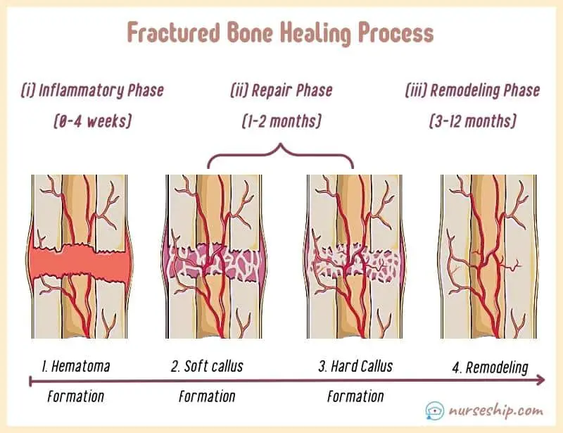 How Broken Bones Heal