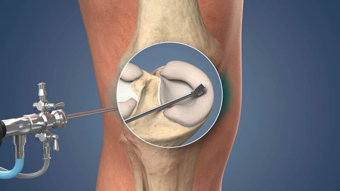 Meniscus Repair
