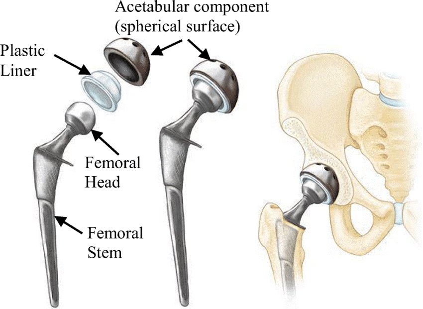 Hip Resurfacing