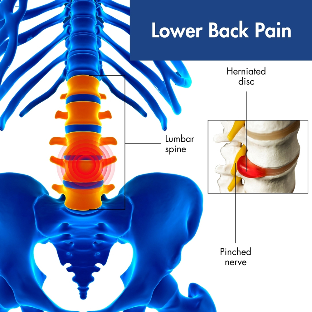 Low Back Pain