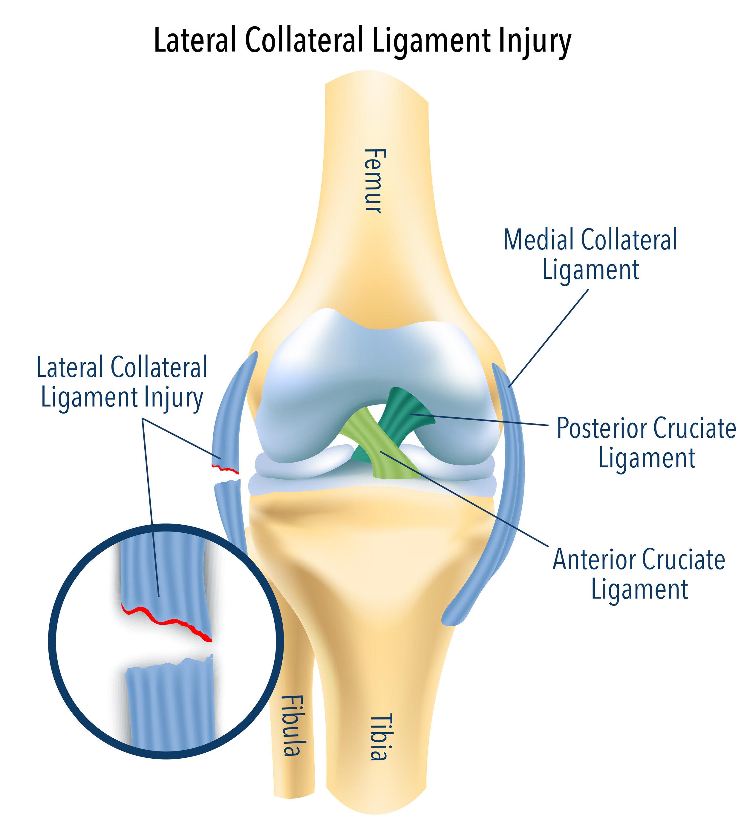 Collateral Ligament Injuries