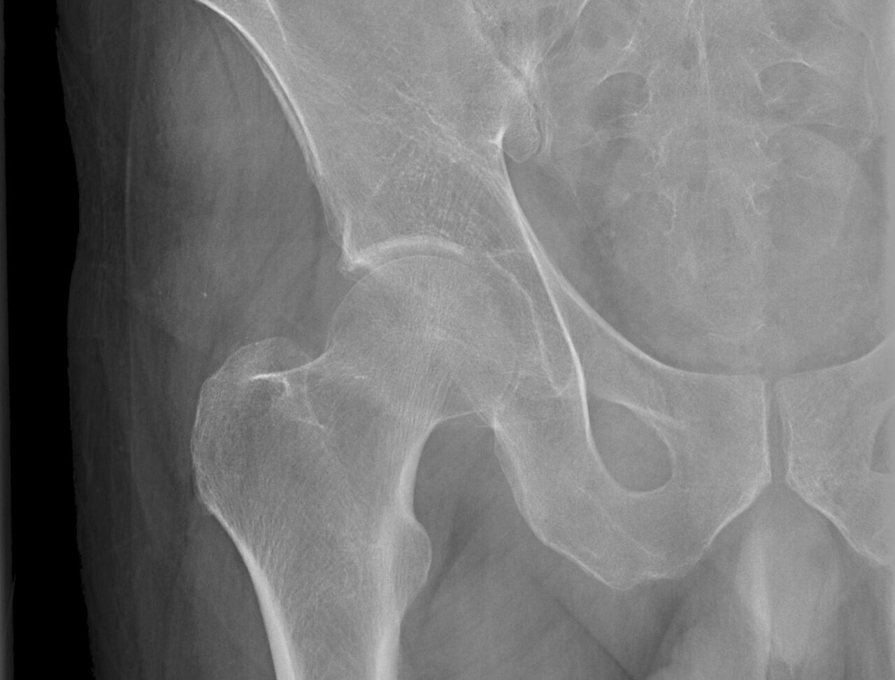 Transient Osteoporosis of the Hip