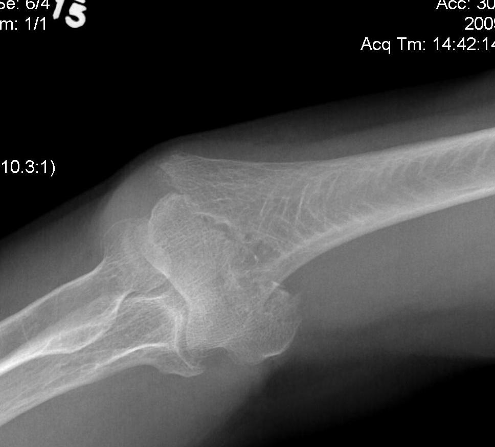 Distal Humerus Fractures of the Elbow