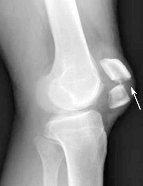 Patellar (Kneecap) Fractures