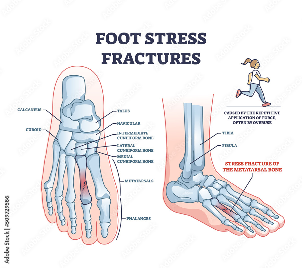 Stress Fractures