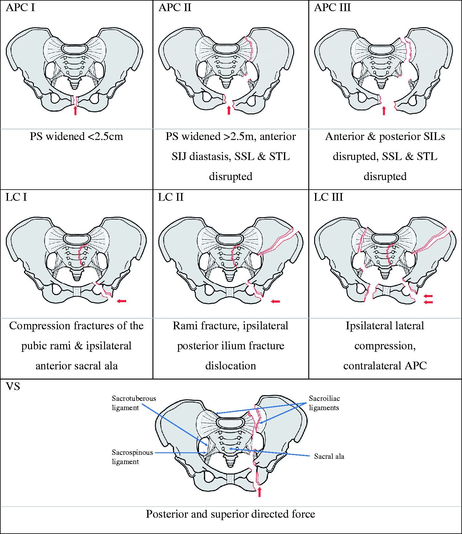 Pelvic Fractures