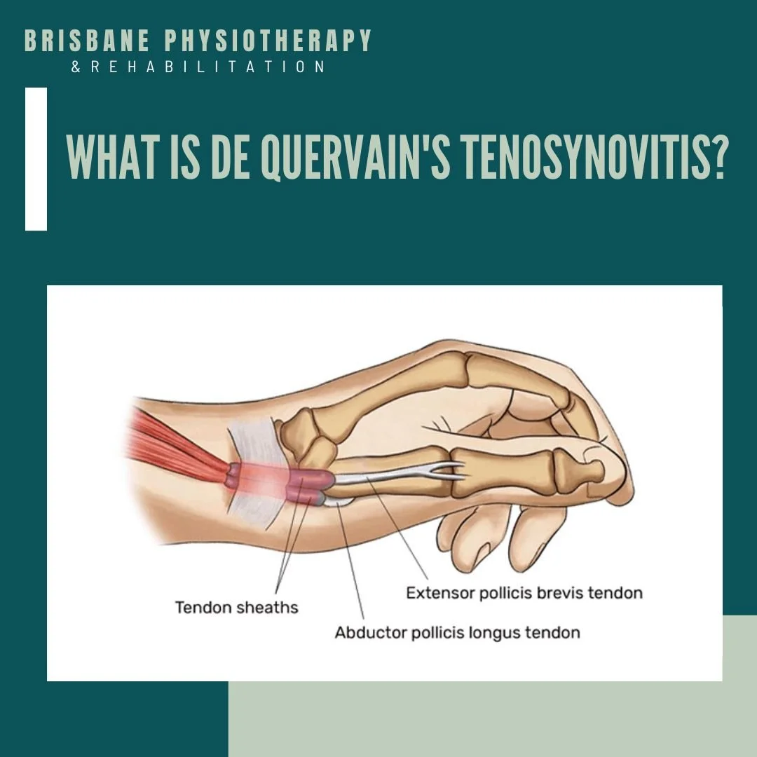 De Quervain's Tenosynovitis