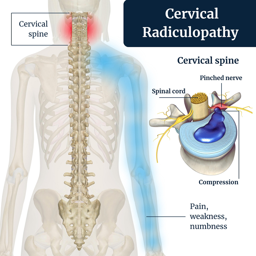 Cervical Radiculopathy (Pinched Nerve)