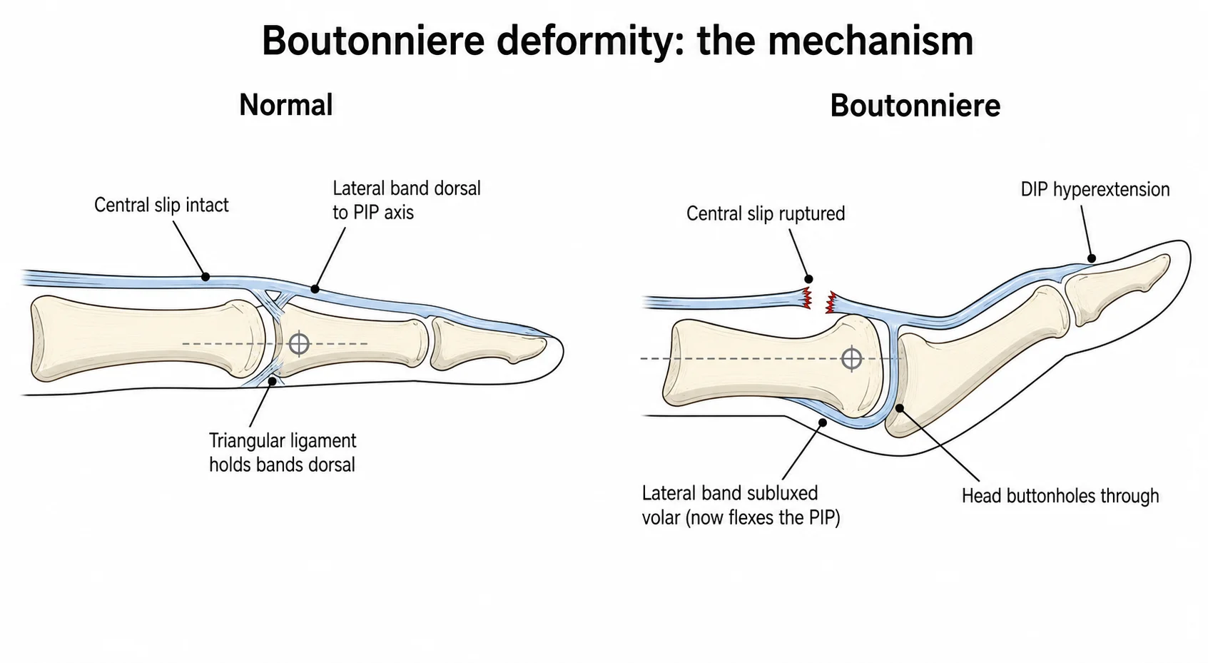 Boutonnière Deformity
