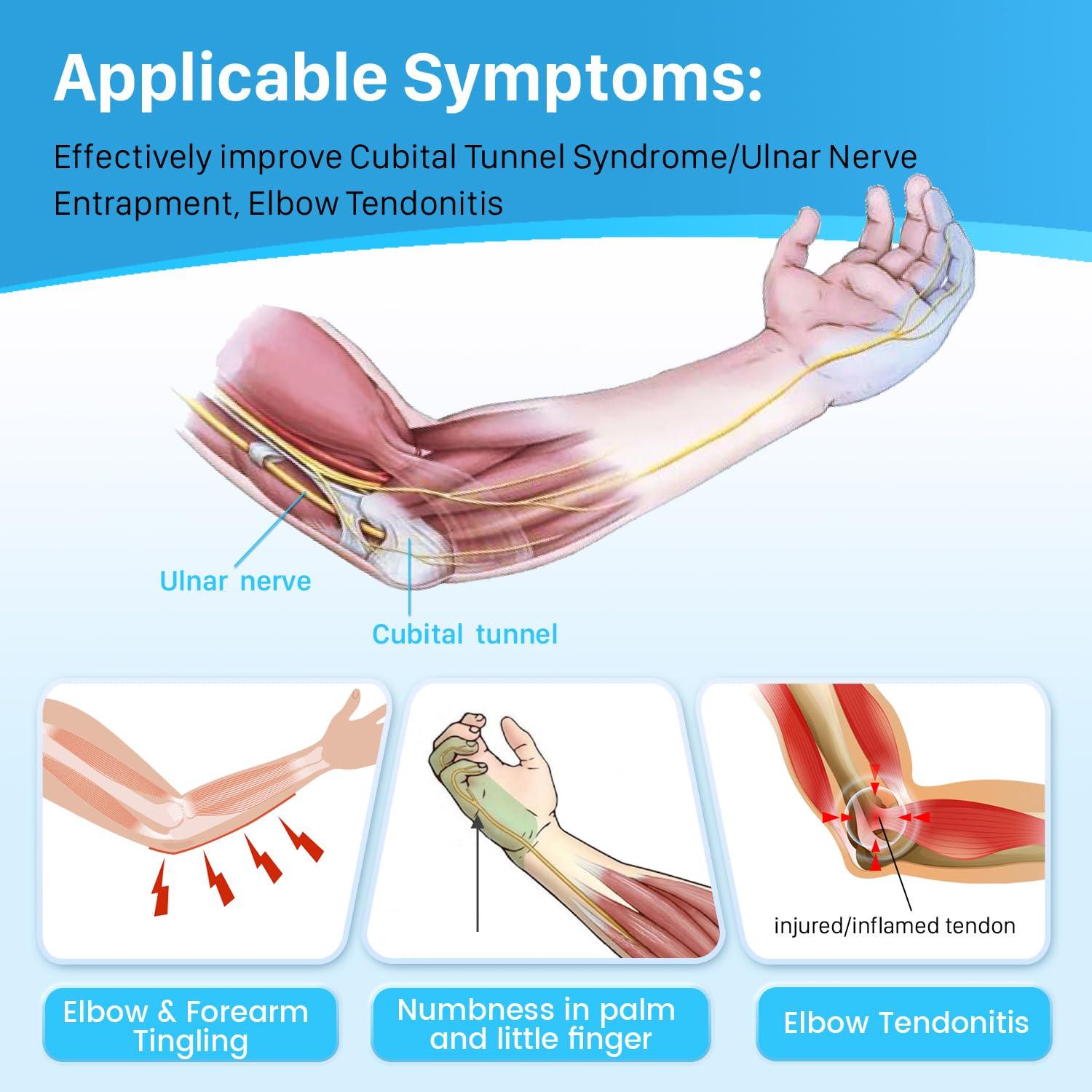 Ulnar Nerve Entrapment at the Elbow (Cubital Tunnel Syndrome)