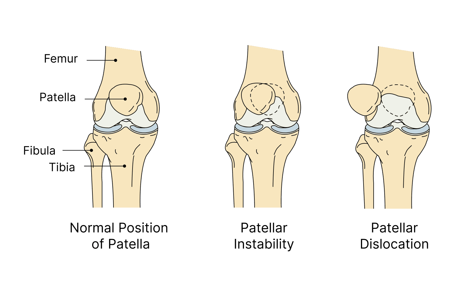 Patellar Dislocation and Instability in Children (Unstable Kneecap)