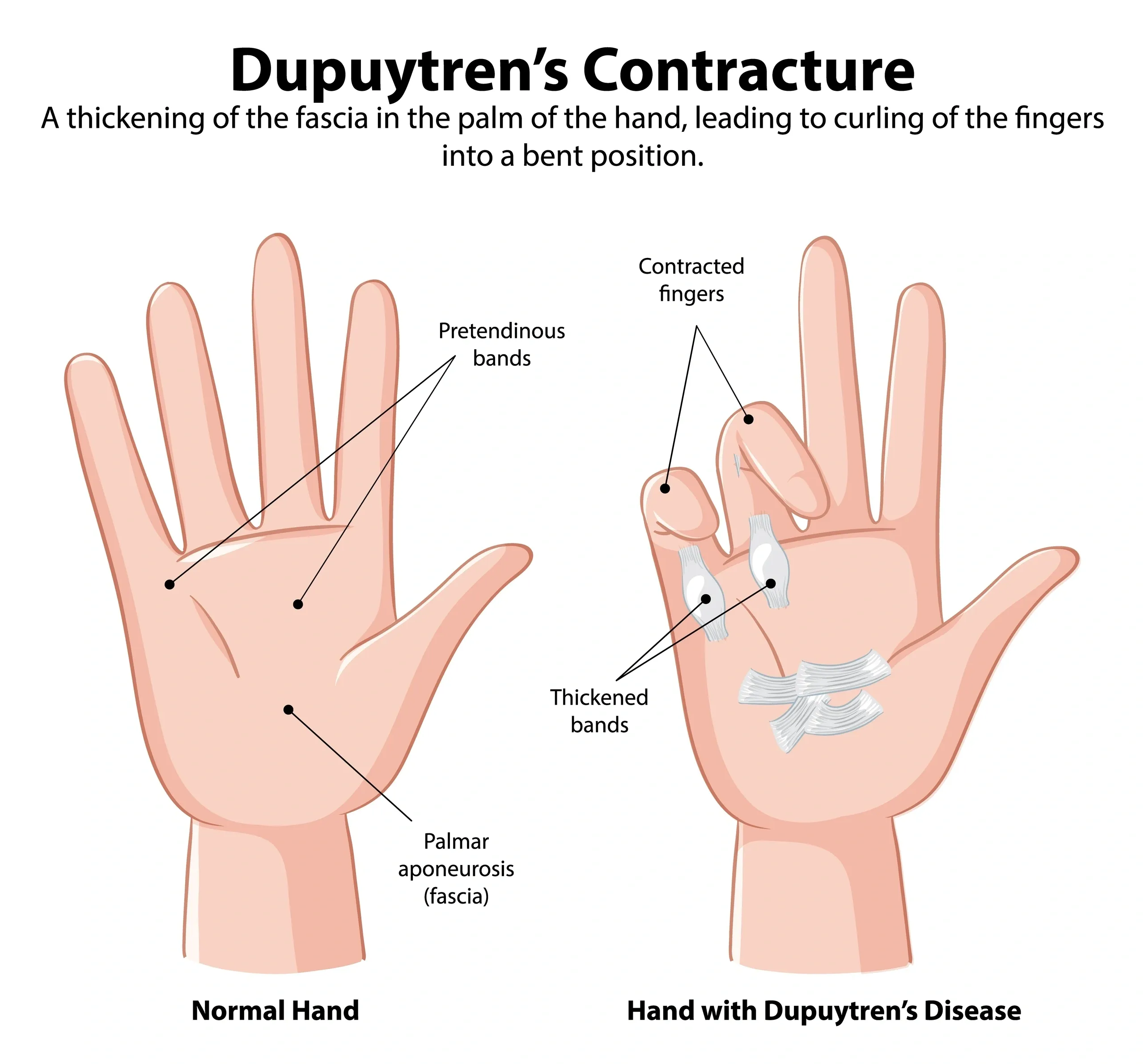 Dupuytren's Disease