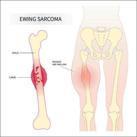 Ewing Sarcoma